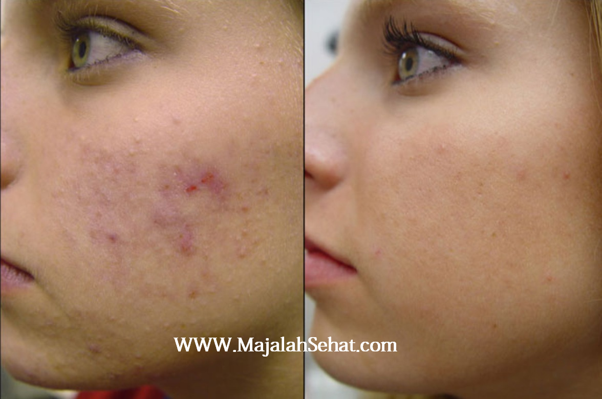 30 Manfaat Santan Kelapa Bagi Kesehatan dan Kecantikan Yang Wajib Anda Ketahui 4